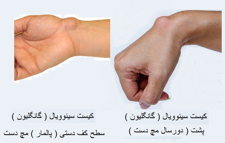 کیست گانگلیون