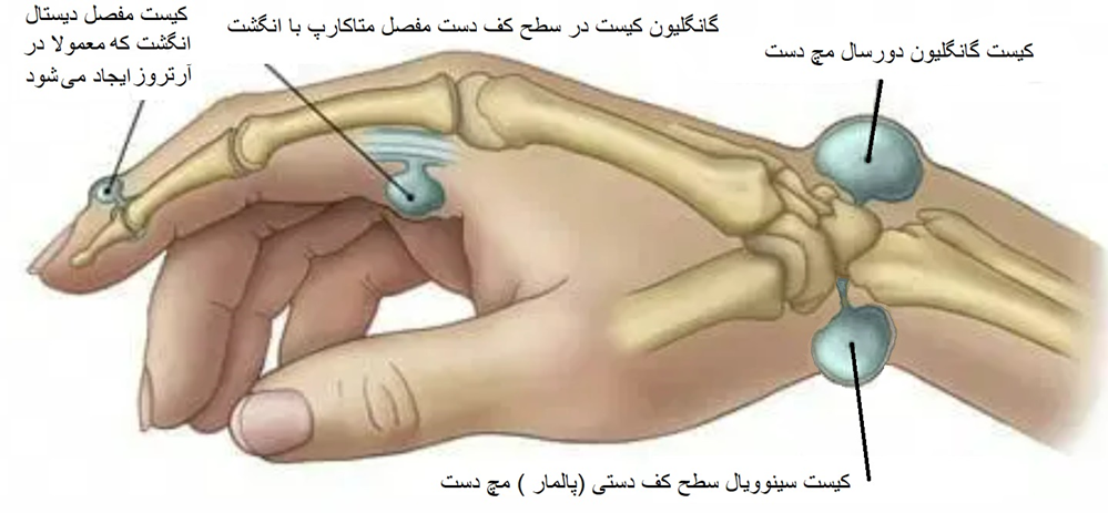 انواع کیست گانگلیون