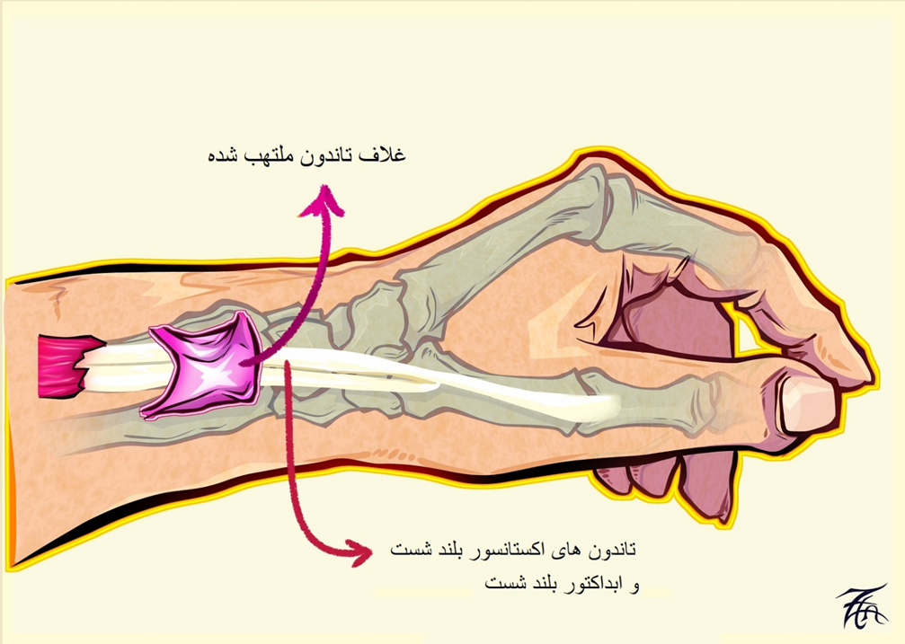 التهاب غلاف تاندون های شست
