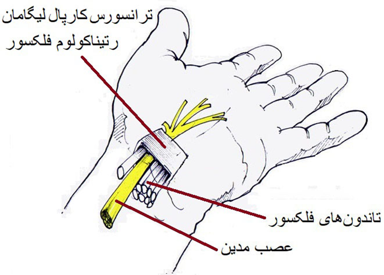 سندروم کارپال تونل