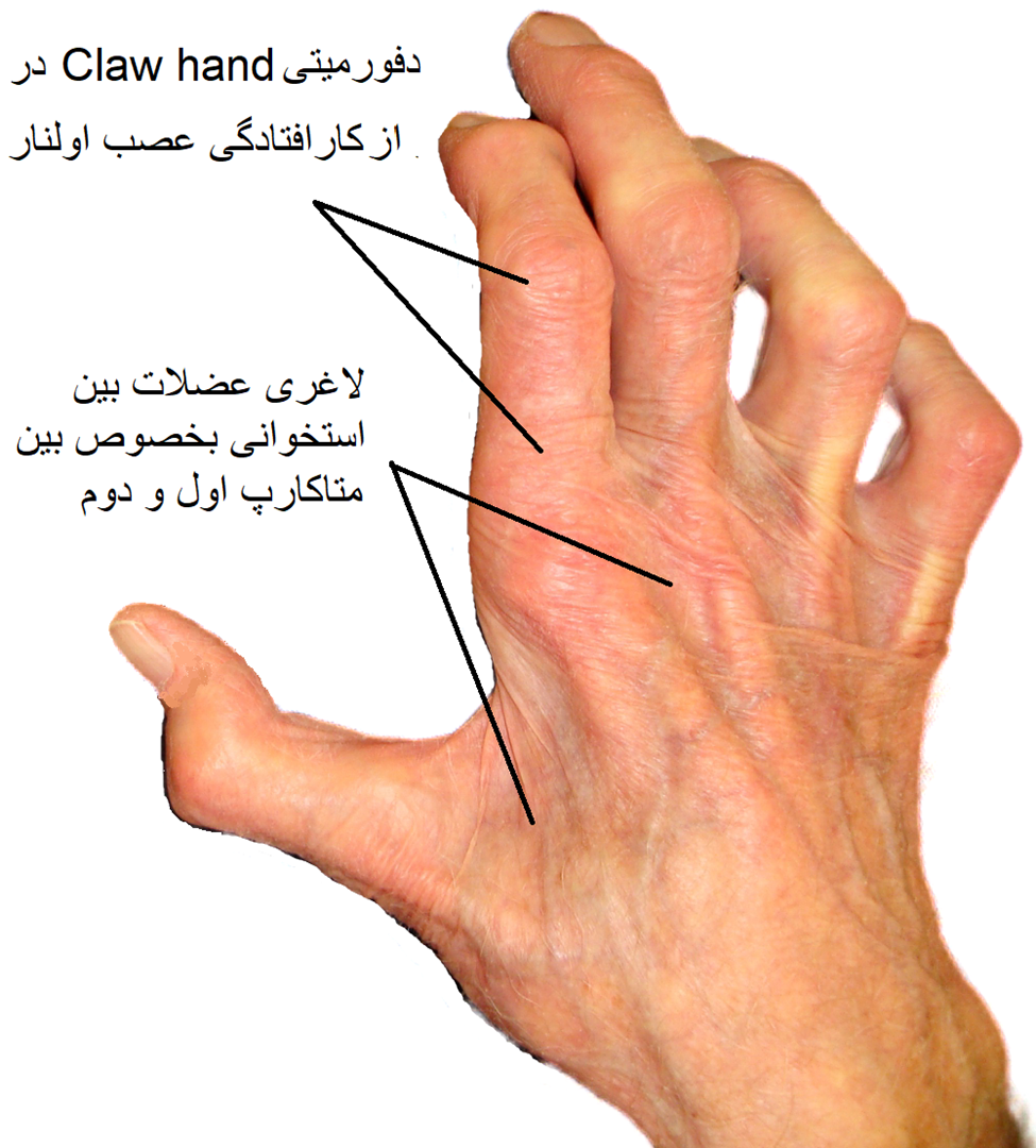 فشار بر عصب اولنار