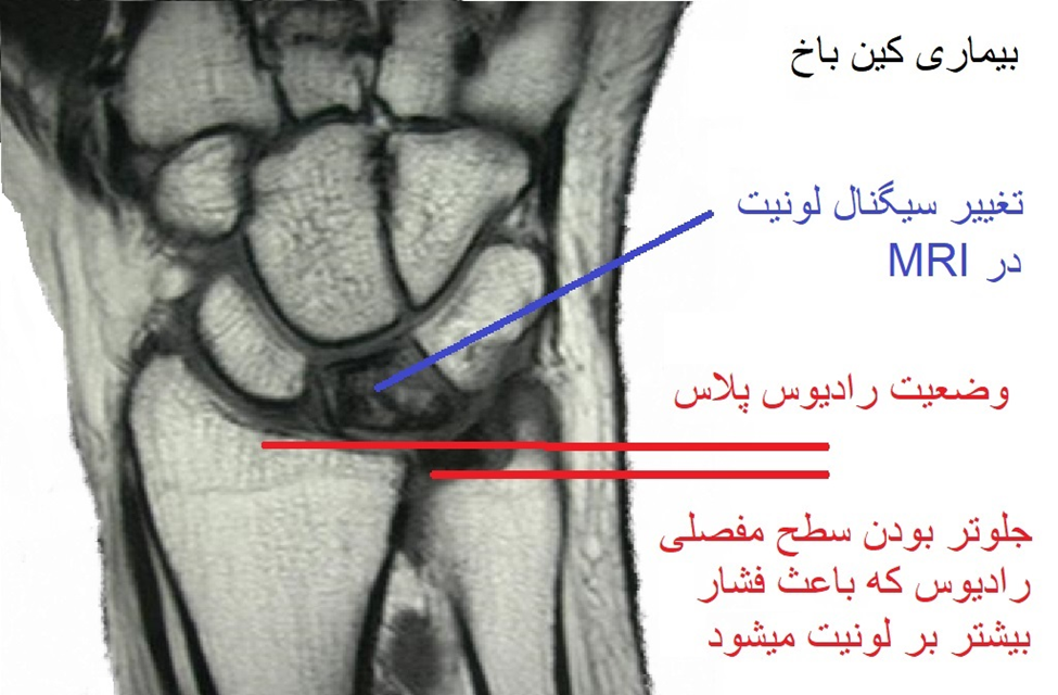 بیماری کین باخ