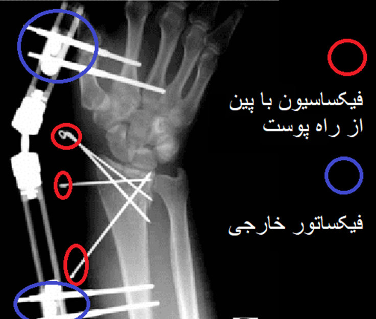 فیکساسیون خارجی و فیکساسیون با پین