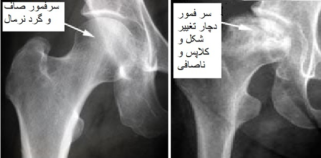 تغییر شکل و کلاپس سر فمور