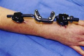 فیکساسیون خارجی مچ دست