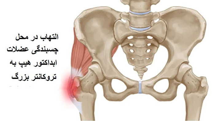 انتزوپاتی هیپ