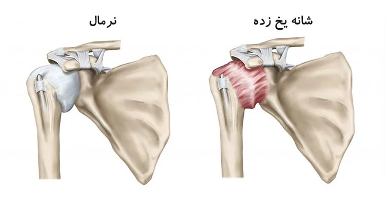 آناتومی شانه یخ زده - فیزیوتراپی در فروزن شولدر