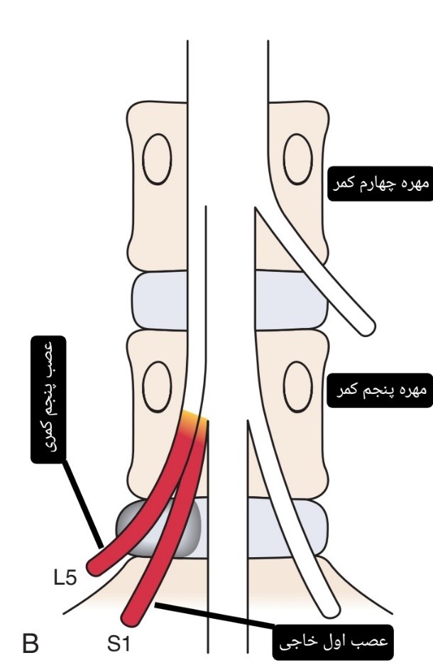 فتق دیسک L5