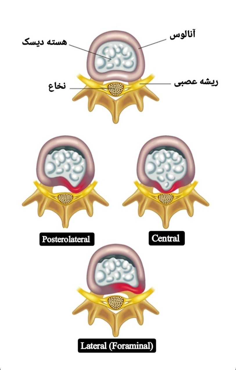انواع فتق دیسک