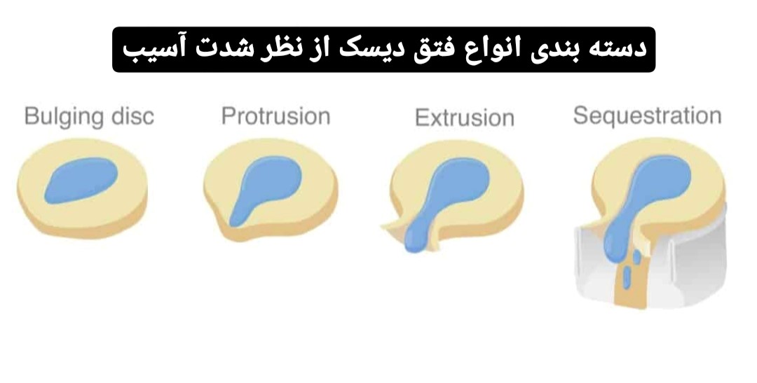 انواع فتق دیسک از نظر شدت آسیب