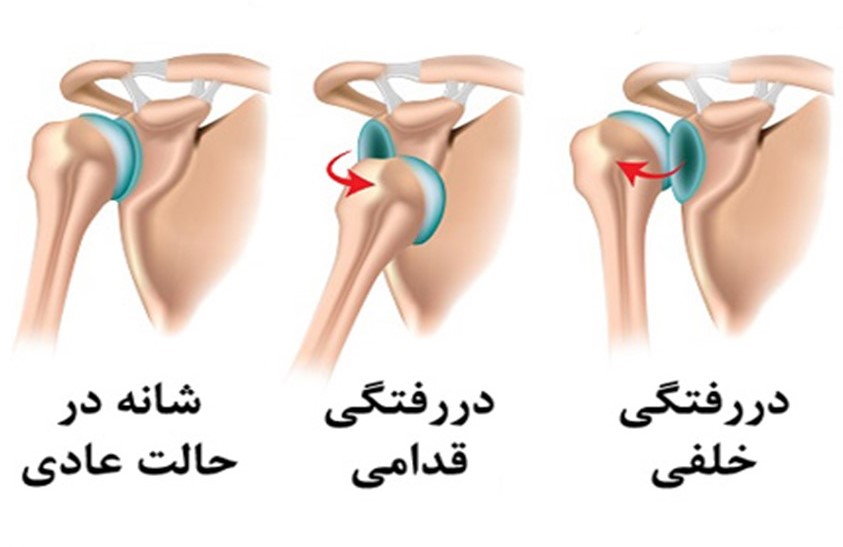 انواع در رفتگی شانه -shoulder instability