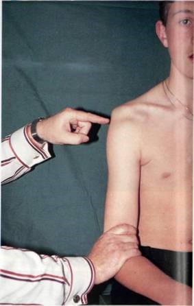 تست sulcus sign