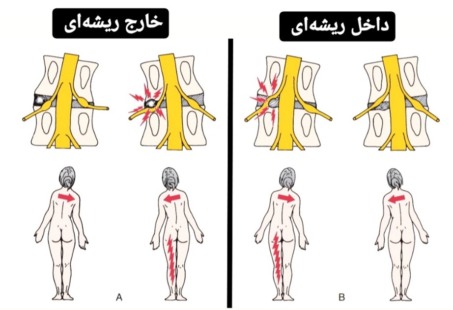 کمردرد-دیسک-فتق دیسک-فیزیوتراپی در فتق دیسک
